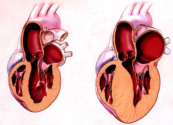 penebalan otot jantung